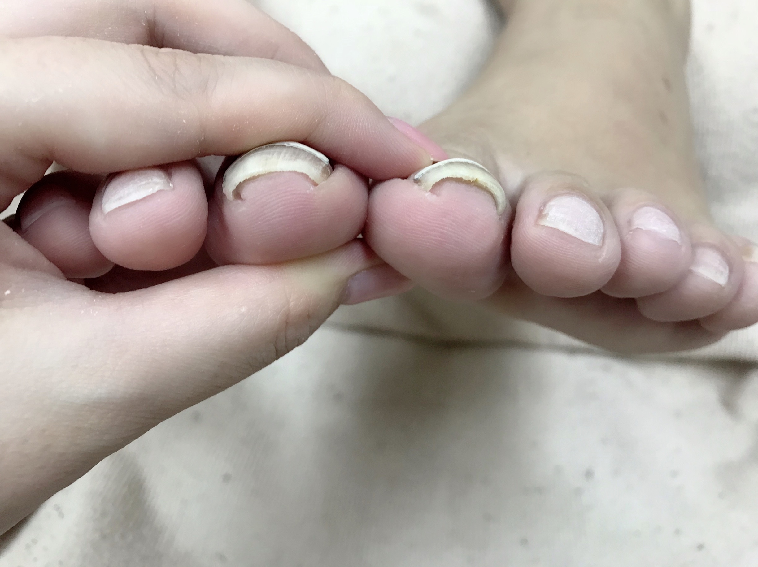 歩くと痛い 巻き爪の原因と予防 公式 ネイル アイラッシュサロンjojo 大阪堂島本店 神戸店 三宮